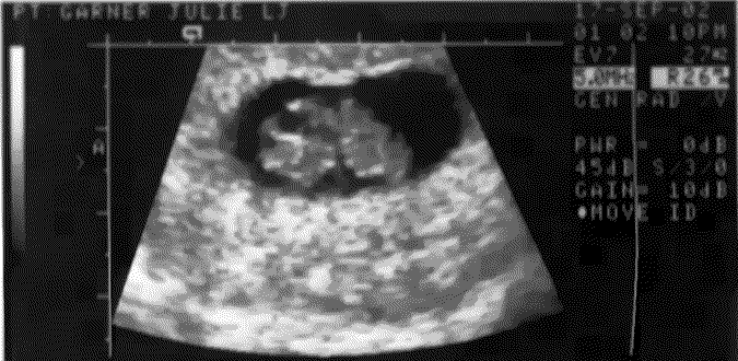 UltraSound Picture#3