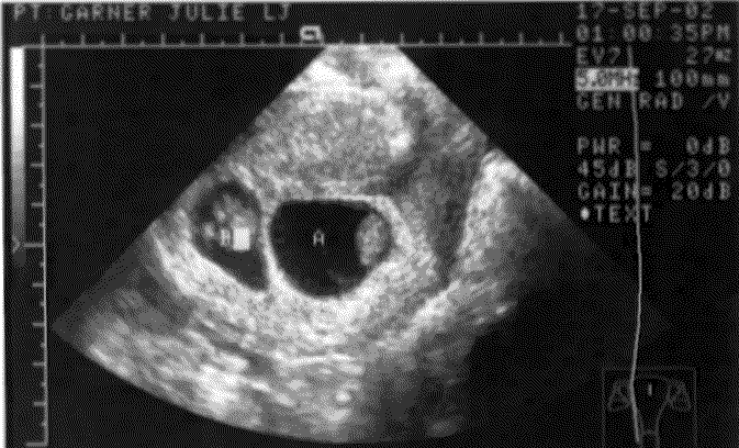 UltraSound Picture#1