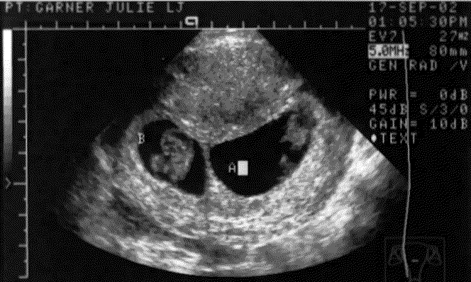 UltraSound Picture#2