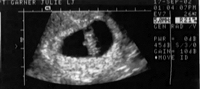UltraSound Picture#4