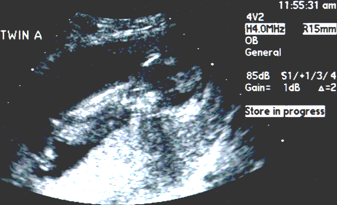 UltraSound Picture#2