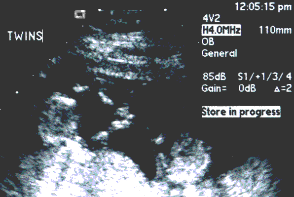 UltraSound Picture#1