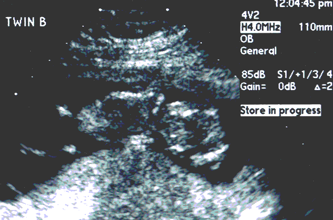UltraSound Picture#3