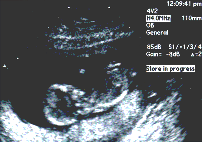 UltraSound Picture#4