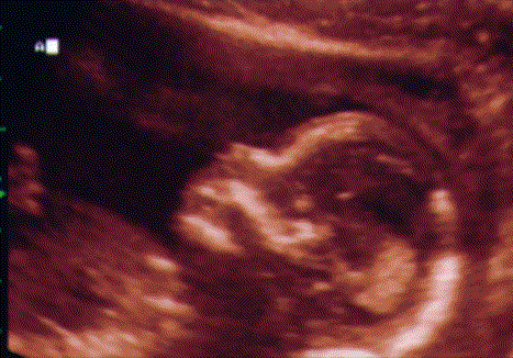 UltraSound Picture#1