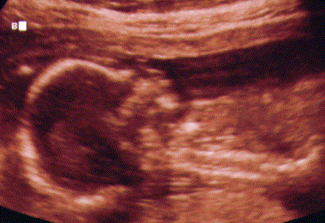 UltraSound Picture#2