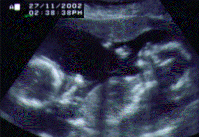 UltraSound Picture#1