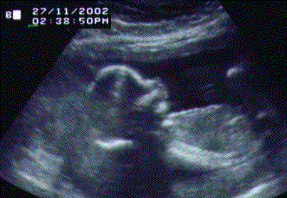 UltraSound Picture#2