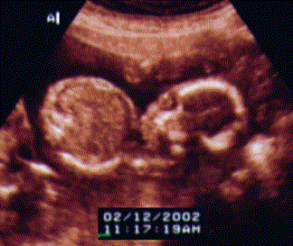 UltraSound Picture#1