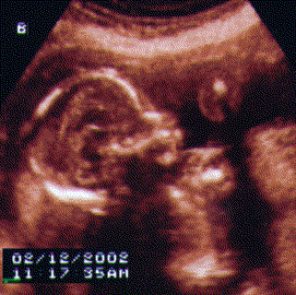 UltraSound Picture#2