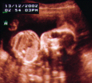 UltraSound Picture#1