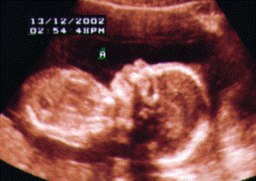 UltraSound Picture#2