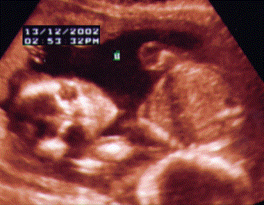 UltraSound Picture#3