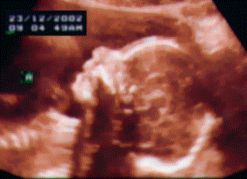 UltraSound Picture#1