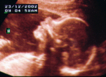 UltraSound Picture#2